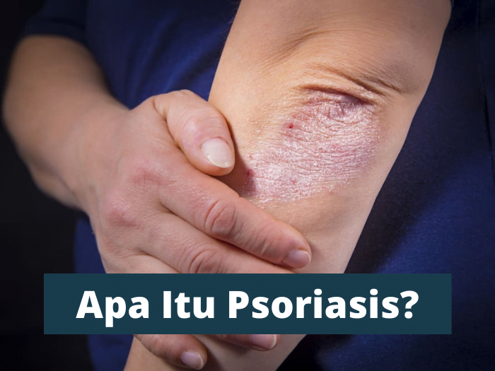 apa itu psoriasis